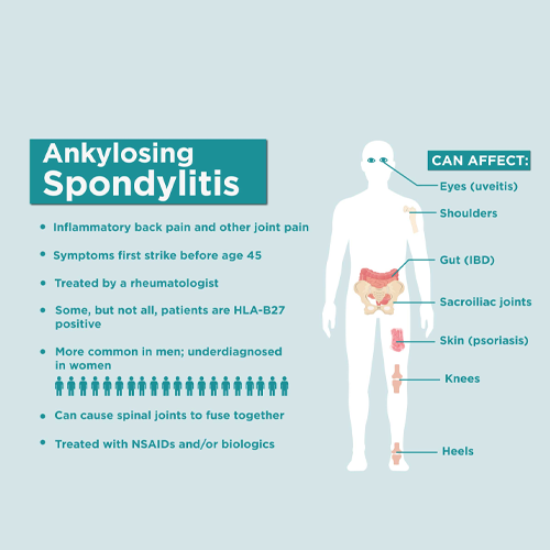 Ankylosing Spondylitis